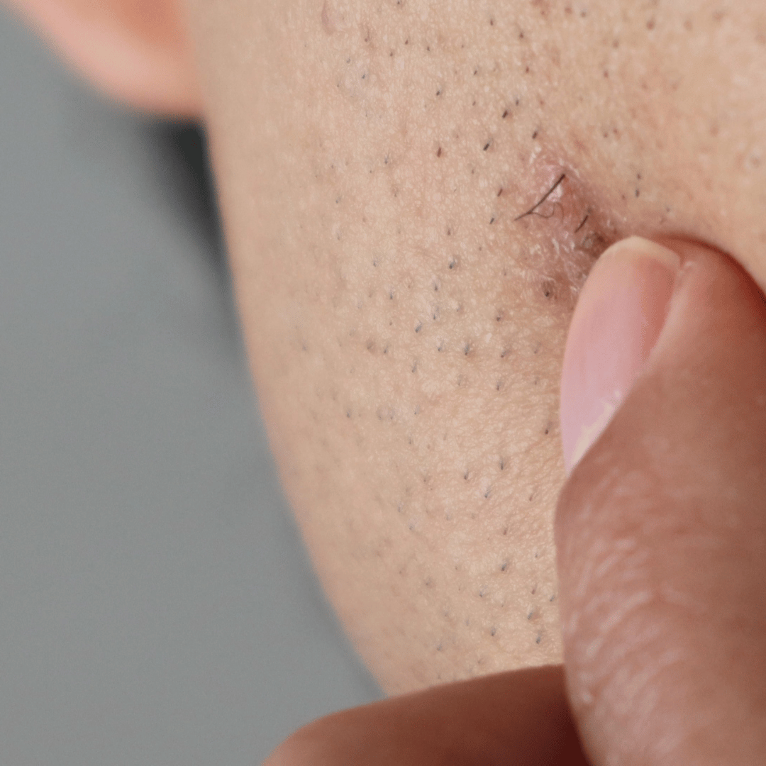 Can Ipl prevent ingrown hair