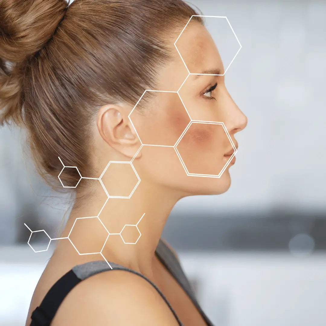 Hyperpigmentation