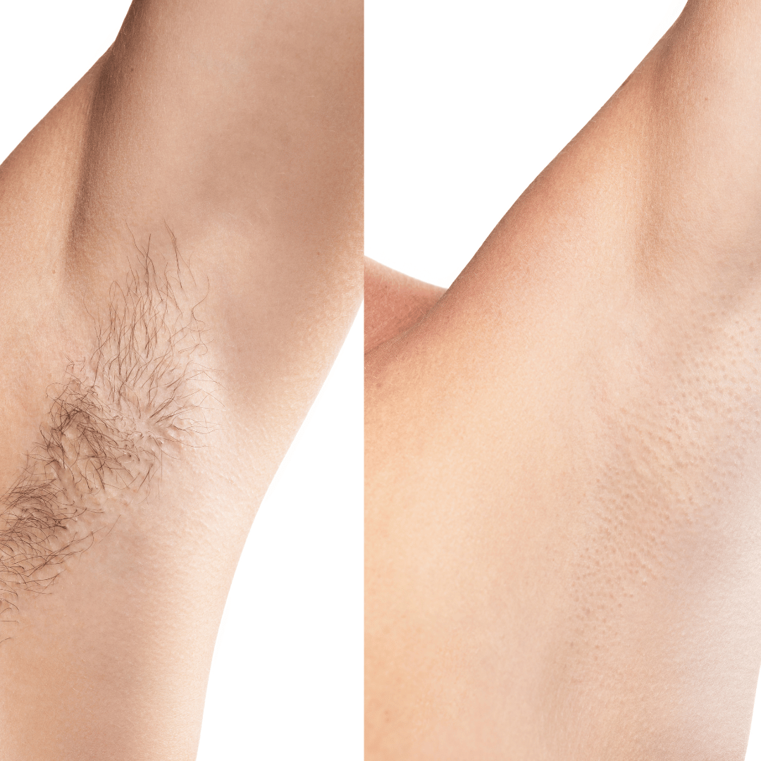 Hair Removal Without the Hassle: Why IPL Beats Shaving and Waxing | SkinTekie