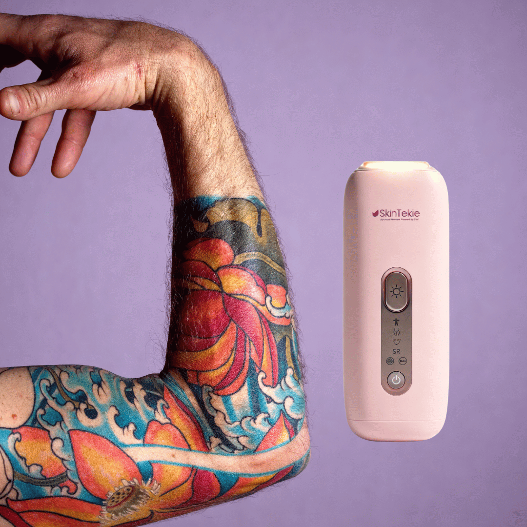 IPL on Tattooed Skin